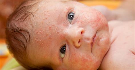 Pictures Of Infant Acne